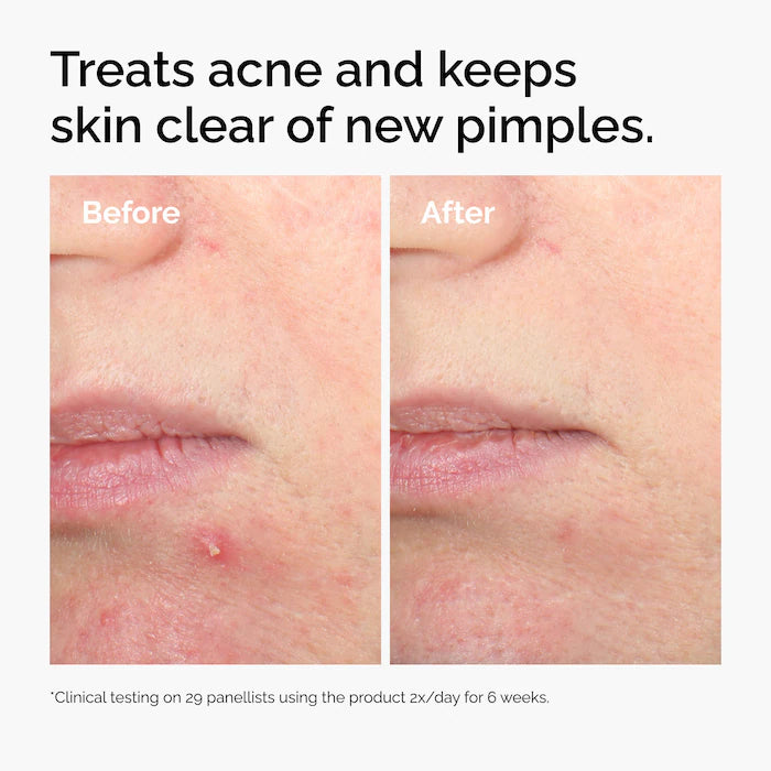 The Ordinary 
Salicylic Acid 2% Solution, Exfoliating Serum for Acne